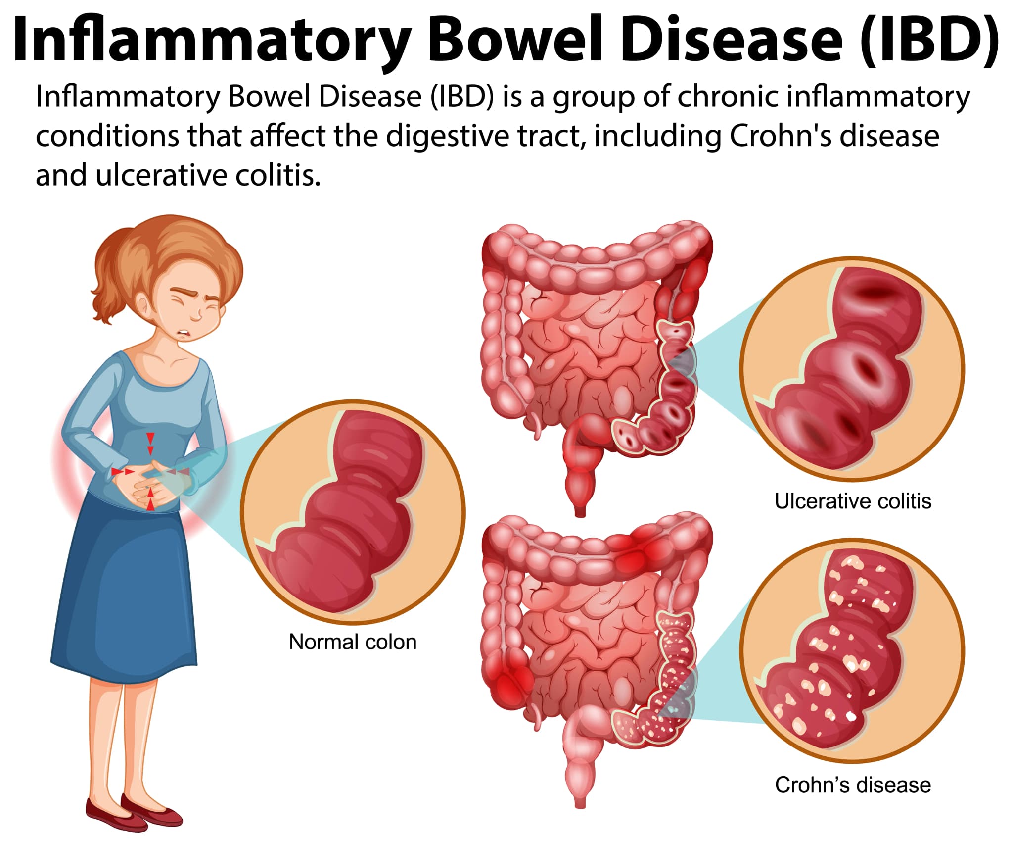 Inflammatory Bowel Disease Treatment