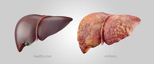 Alcohol Liver Disease